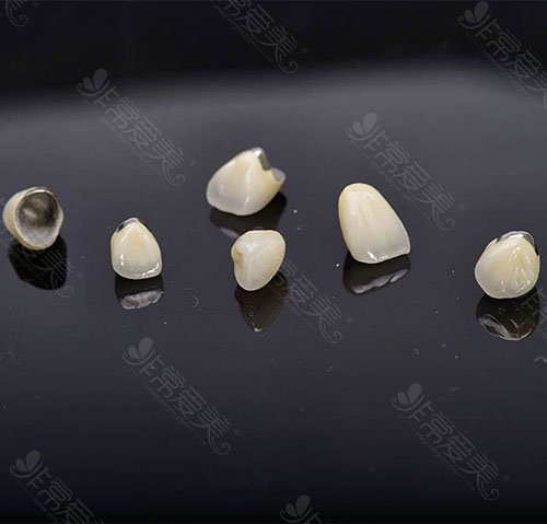 钴铬烤瓷牙做牙齿修复优势有哪些