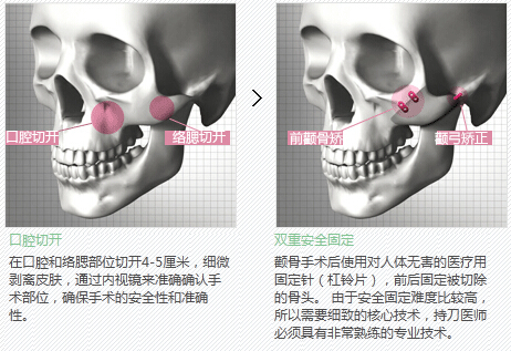 面部轮廓手术针对哪些部位？手术方式是什么？