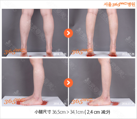 韩国365mc吸脂医院小腿抽脂
