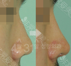 韩国4月31日整形外科鼻尖整形图