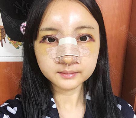 韩国娜娜整形外科眼鼻整形四天照片