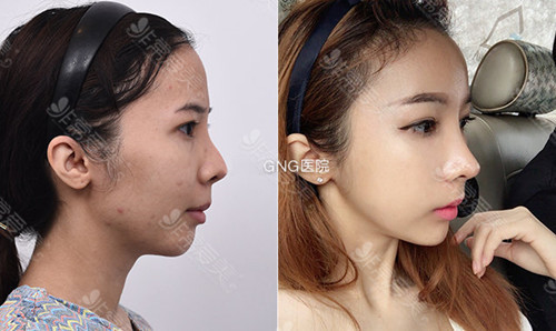 韩国gng整形外科隆鼻手术对比