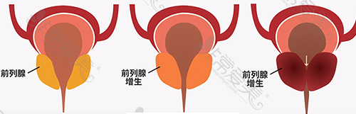 男性前列腺肥大增生变化阶段图示
