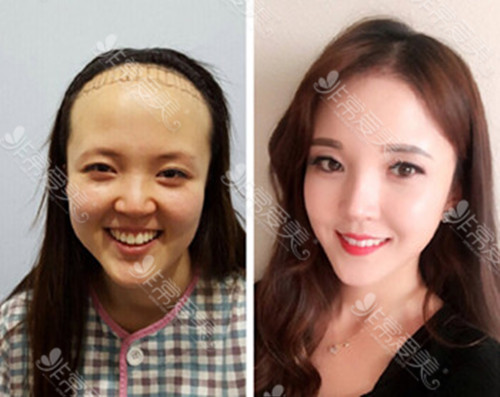 植发后掉发是手术失败了吗？韩国植发效果受哪些因素影响?