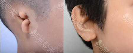 韩国普罗菲耳小耳症矫正对比图