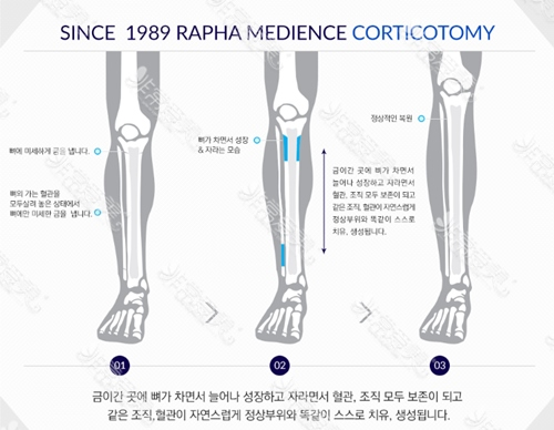 韩国rapha增高四肢整形医院术法详解