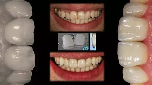 水晶锆修复牙齿案图