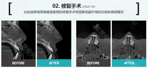 韩国现代美学整形医院鼻子整形成功CT图