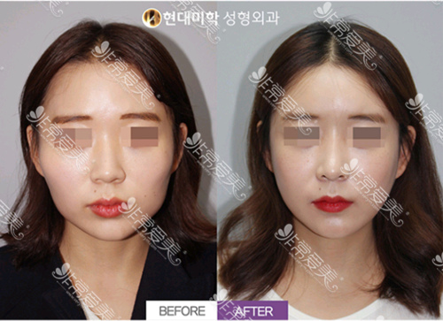韩国面部轮廓手术哪里做得好
