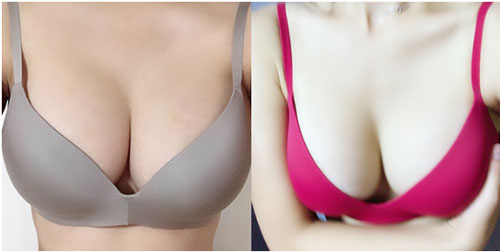 韩国mbw整形外科隆胸效果展示
