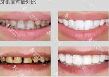 全瓷牙有几种材质扫盲贴！韩国日本都常用树脂还是其他？