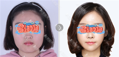 韩国轮廓手术模拟器对比图