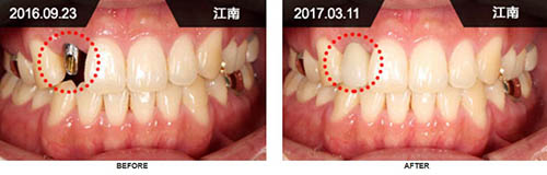 韩国来一菲牙科牙齿种植前后对比日记