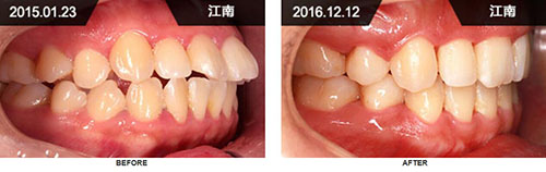 韩国来一菲牙科牙齿矫正前后对比案例