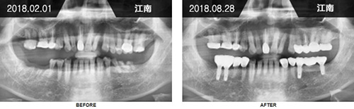 韩国来一菲牙科医院种植牙CT图片