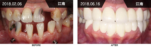 韩国来一菲牙科医院牙齿修复前后对比日记