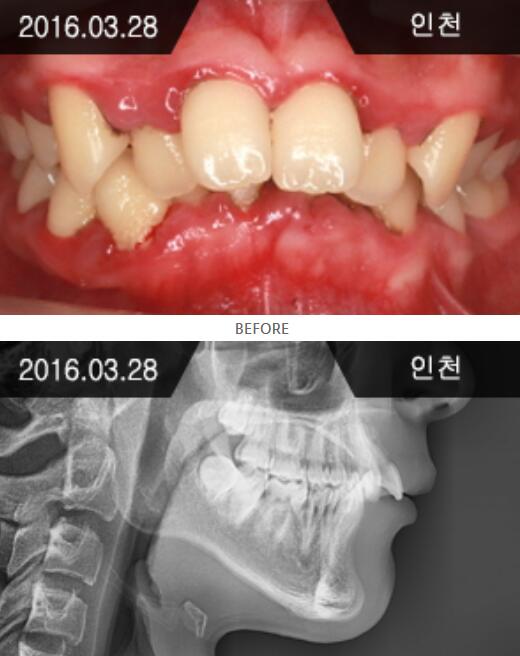 韩国来一菲牙科牙齿矫正术前照片