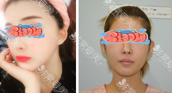 韩国绮林整形外科面部轮廓案例
