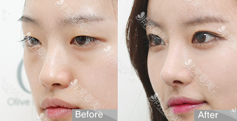 韩国olive整形外科双眼皮
