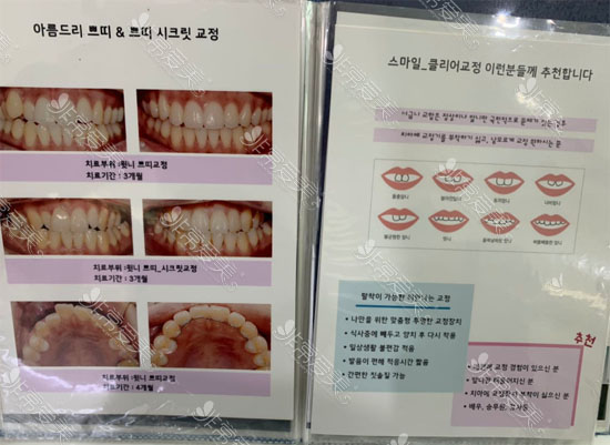 韩国牙科收费价目表谁那有？全瓷牙矫正分别多少钱？