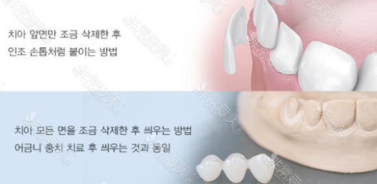 韩国全瓷牙价目表