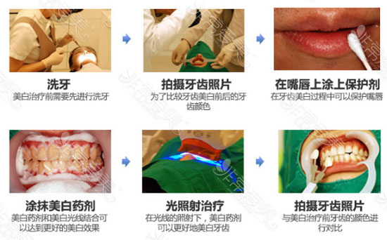 韩国牙齿美白治疗过程图