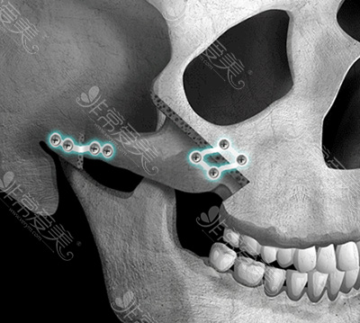 常见颧骨缩小术使用钛钉固定图示
