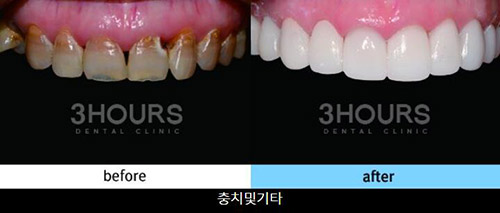 韩国三小时牙齿贴面改善前后对比