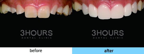 韩国三小时齿科全瓷牙贴片治疗前后对比