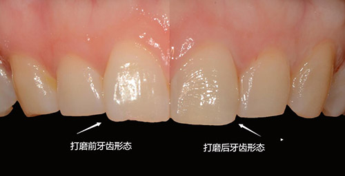 韩国三小时牙科做牙齿贴面打磨牙齿对比