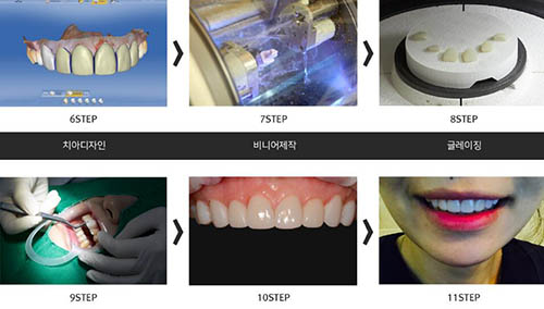 韩国三小时牙科做牙齿贴面过程步骤