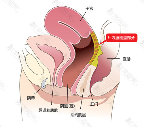 后方膣圆盖术部分