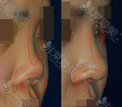 韩国rcoco整形外科隆鼻前后对比图
