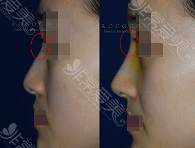 韩国rcoco整形外科隆鼻图