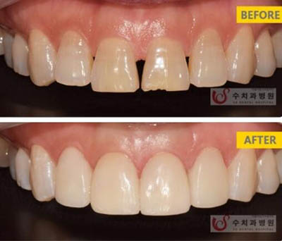 韩国SU牙科医院烤瓷牙贴面矫正前后照片