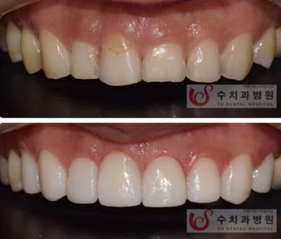 韩国SU牙科矫正牙齿不齐瓷贴面治疗