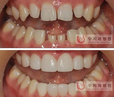 韩国SU（秀）牙科医院烤瓷牙贴面整形案例