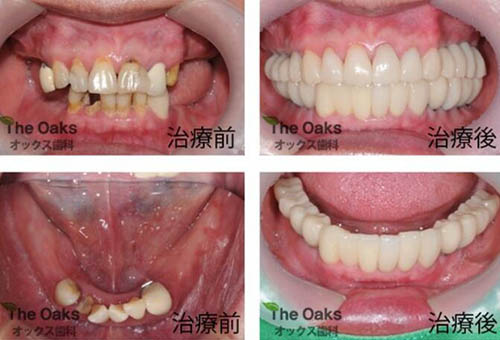 韩国Oaks沃科斯牙科种植牙前后对比案例