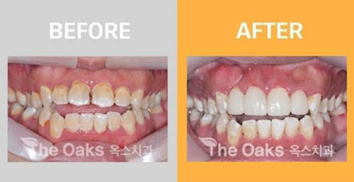 韩国Oaks沃科斯牙科牙齿美白改善案例