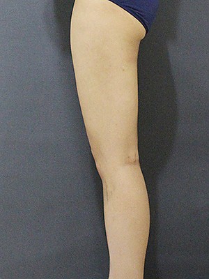 韩国爱林吸脂瘦大腿真人案例