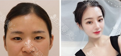 韩国双眼皮修复好的医生有哪些?科普双眼皮修复较佳时间!