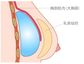 隆胸假体植入部位示意图
