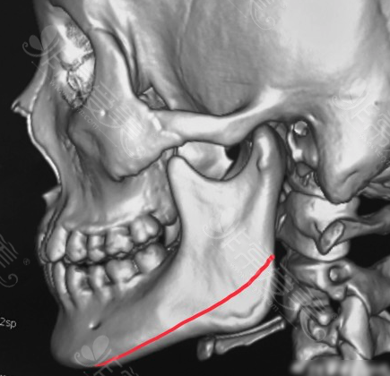 下颌骨截骨手术ct大概描述