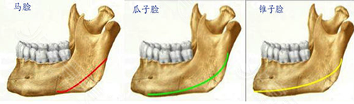 截骨量不容易造成的术后下颌形态