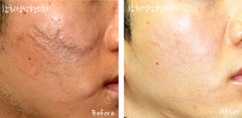 韩国凹陷性疤痕通常有这几种治疗方案,真皮再生术有用吗？