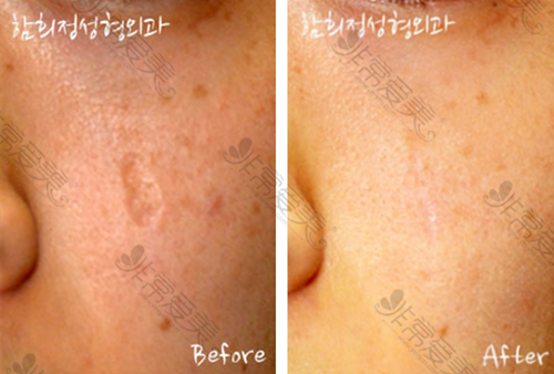 韩国Dr.ham's整形医院面部疤痕修复