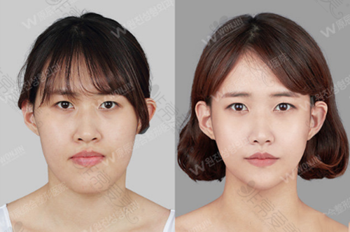 韩国原辰医院面部轮廓手术