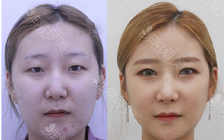 韩国一路美整形外科轮廓术前后对比