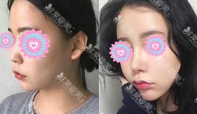 韩国thenan整形外科隆鼻风格是什么