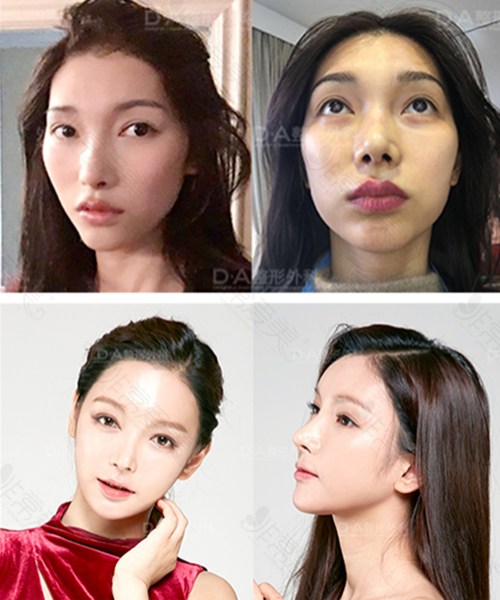 韩国DA整形外科面部轮廓手术